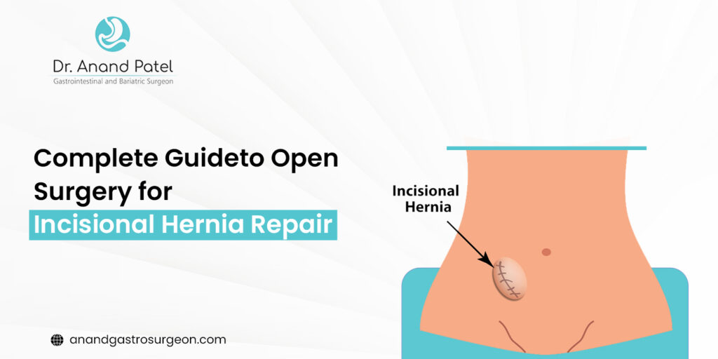Complete Guide to Open Surgery for Incisional Hernia Repair